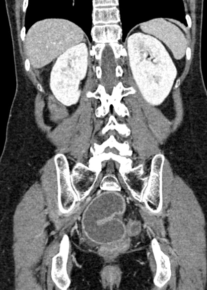 Adhesional small bowel obstruction (Radiopaedia 48397-53305 Coronal C+ portal venous phase 263).jpg