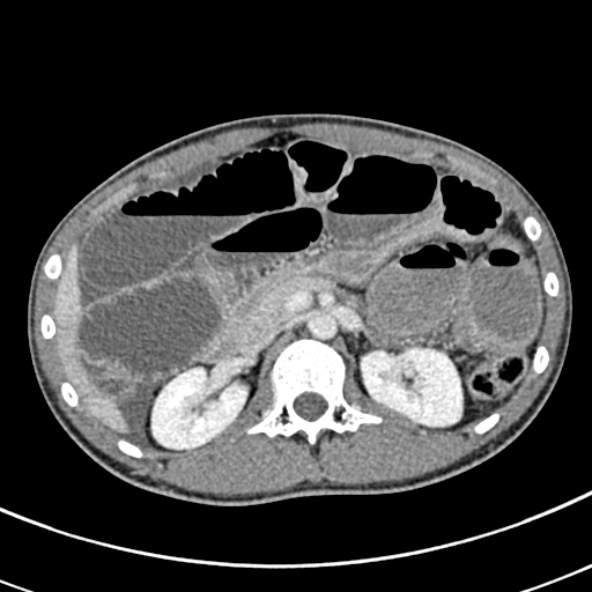 Adhesional small bowel obstruction (Radiopaedia 52107-57980 Axial C+ portal venous phase 39).jpg