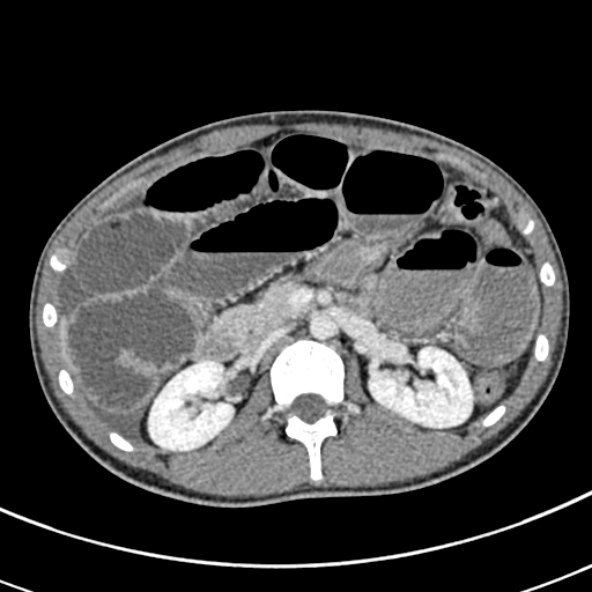 File:Adhesional small bowel obstruction (Radiopaedia 52107-57980 Axial C+ portal venous phase 42).jpg