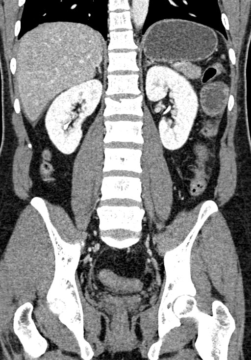 Adhesional small bowel obstruction (Radiopaedia 58900-66131 Coronal C+ portal venous phase 170).jpg
