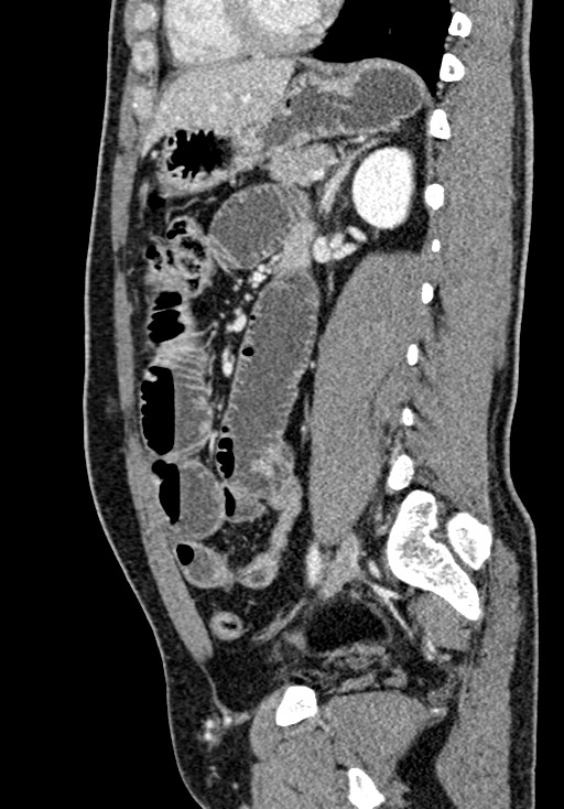 Adhesional small bowel obstruction (Radiopaedia 58900-66131 Sagittal C+ portal venous phase 154).jpg