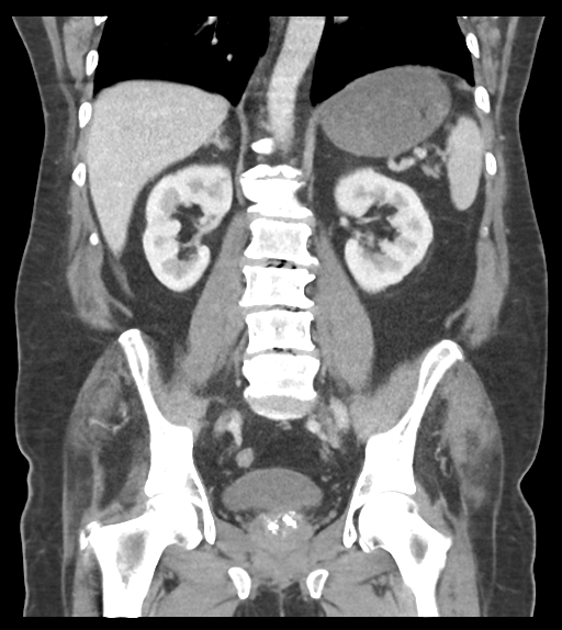 Adhesions within abdominal wall hernia (Radiopaedia 58283-65394 Coronal C+ portal venous phase 46).png