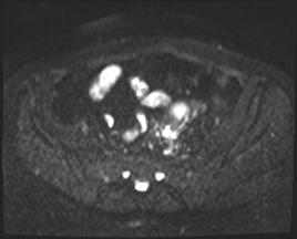 File:Adnexal multilocular cyst (O-RADS US 3. O-RADS MRI 3) (Radiopaedia 87426-103754 Axial 146).jpeg