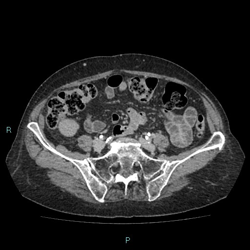 File:Adrenal collision tumor (ACT) (Radiopaedia 48462-53379 Axial C+ delayed 47).jpg