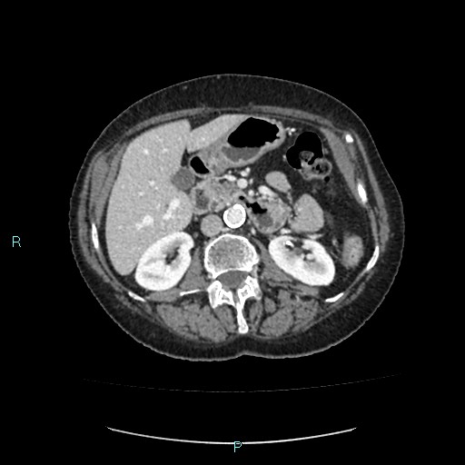 File:Adrenal collision tumor (ACT) (Radiopaedia 48462-53379 Axial C+ portal venous phase 24).jpg