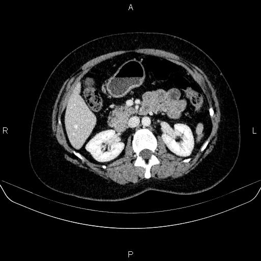 Adrenal cortical carcinoma (Radiopaedia 84882-100379 Axial C+ portal venous phase 36).jpg
