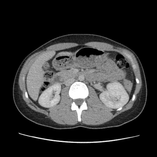 Adrenal cyst (Radiopaedia 64869-73813 Axial C+ portal venous phase 33).jpg