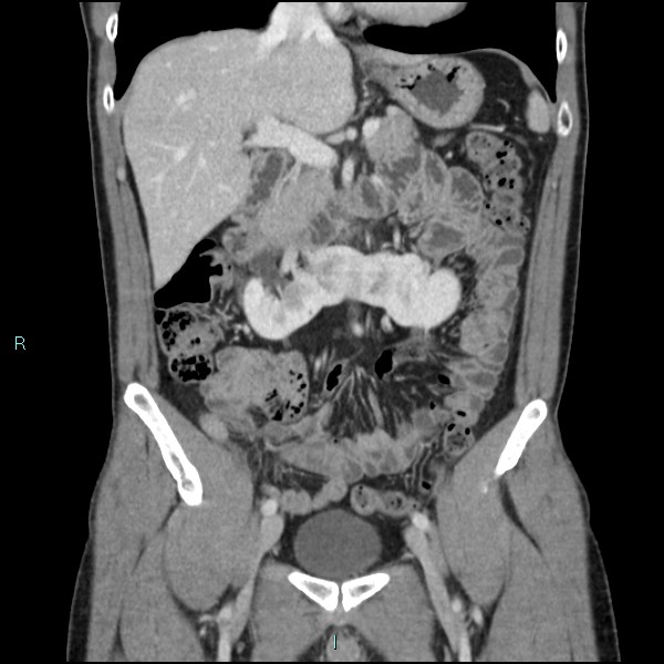 Adrenal cystic lymphangioma (Radiopaedia 83161-97534 Coronal C+ portal venous phase 31).jpg