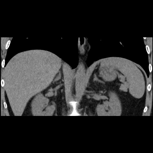 Adrenal gland trauma (Radiopaedia 81351-95079 Coronal non-contrast 53).jpg