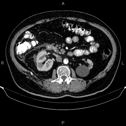 Adrenal hemorrhage (Radiopaedia 62622-70916 Axial C+ arterial phase 176).jpg