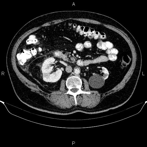Adrenal hemorrhage (Radiopaedia 62622-70916 Axial C+ portal venous phase 87).jpg