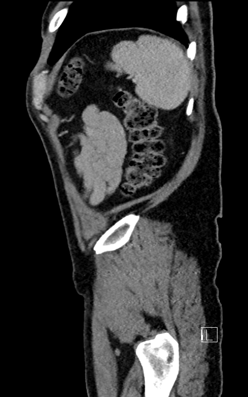 Adrenal lymphoma (Radiopaedia 73730-84529 Sagittal C+ portal venous phase 99).jpg