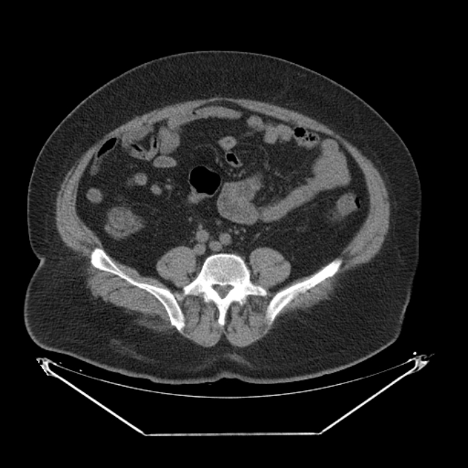 Adrenal myelolipoma (Radiopaedia 26278-26407 Axial non-contrast 47).jpg