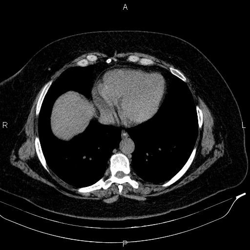 Adrenal myelolipoma (Radiopaedia 84319-99617 Axial With oral contrast 18).jpg