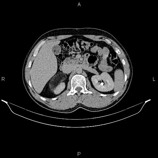 Adrenal myelolipoma (Radiopaedia 87794-104246 Axial renal excretory phase 35).jpg