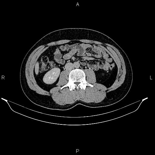Adrenal myelolipoma (Radiopaedia 87794-104246 Axial renal excretory phase 52).jpg