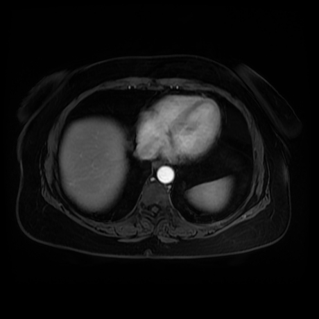 Adrenal myelolipoma - MRI (Radiopaedia 83249-97646 T1 fat sat arterial phase 1).jpg