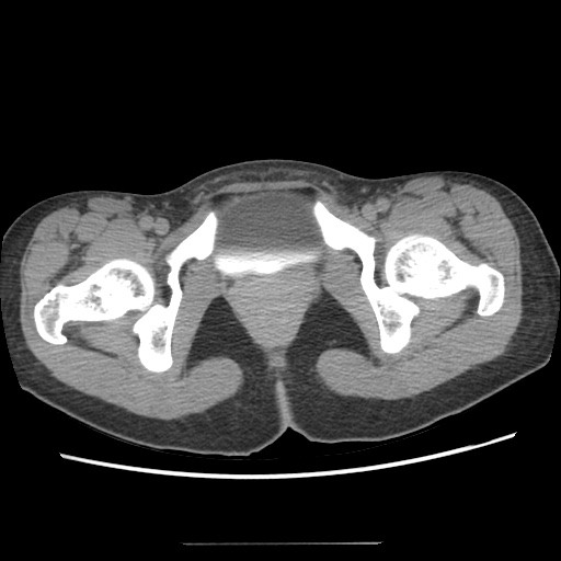 Adult polycystic kidney disease (Radiopaedia 48845-53876 Axial renal excretory phase 96).jpg