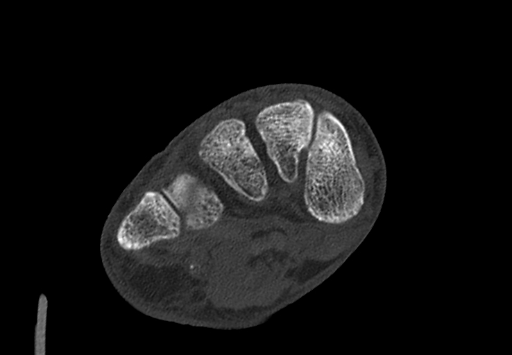 Advanced osteomyelitis due to open metatarsal fracture (Radiopaedia 83891-99095 Axial bone window 24).jpg