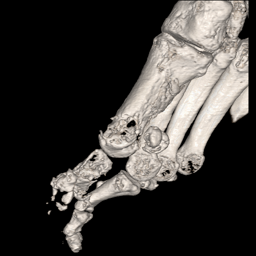 File:Advanced osteomyelitis due to open metatarsal fracture (Radiopaedia 83891-99095 VRT 1).jpg