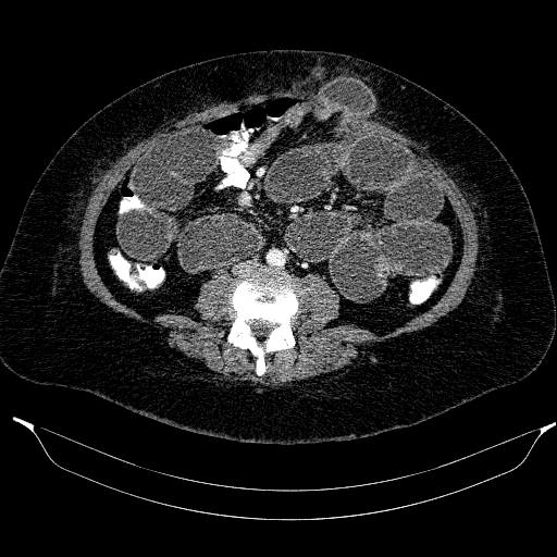 Afferent loop syndrome - secondary to incarcerated trocar site hernia (Radiopaedia 82959-97305 Axial C+ portal venous phase 139).jpg