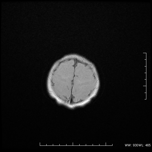 File:Agenesis of the corpus callosum (Radiopaedia 16190-16010 Axial T1 15).png