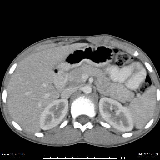 Agenesis of the gallbladder (Radiopaedia 55454-61905 B 30).jpg