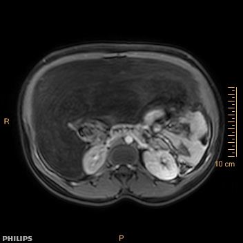 File:Aggressive angiomyxoma (Radiopaedia 73343-84093 Axial T1 C+ fat sat 165).jpg