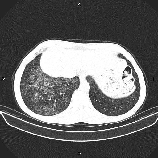 Air bronchogram in pneumonia (Radiopaedia 85719-101512 Axial lung window 56).jpg