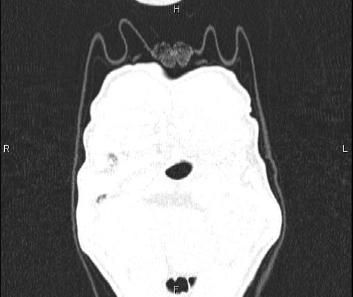 Air bronchogram in pneumonia (Radiopaedia 85719-101512 Coronal lung window 2).jpg