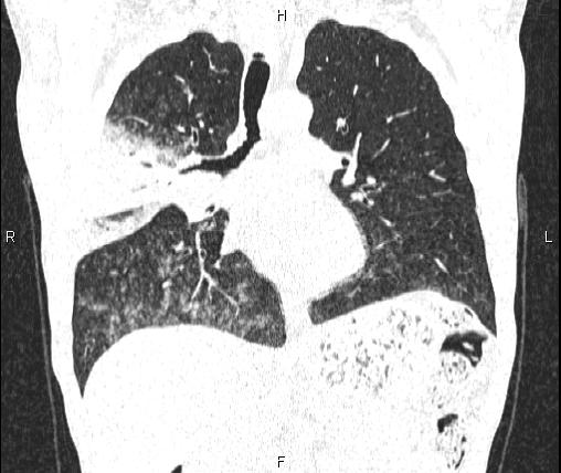Air bronchogram in pneumonia (Radiopaedia 85719-101512 Coronal lung window 30).jpg