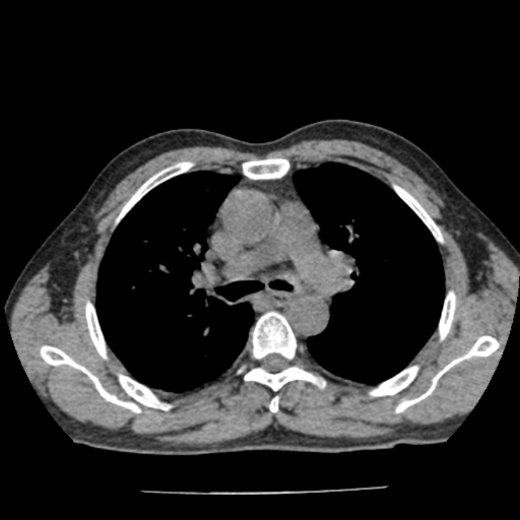 Airway foreign body in adult (Radiopaedia 85907-101779 Axial liver window 60).jpg