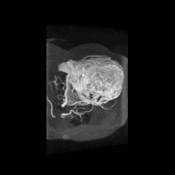 Alveolar soft part sarcoma (Radiopaedia 64501-73678 D 11).jpg