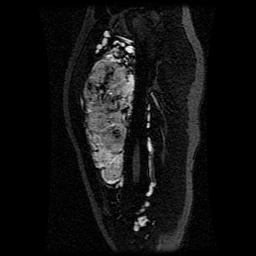 Alveolar soft part sarcoma (Radiopaedia 64501-73678 D 85).jpg