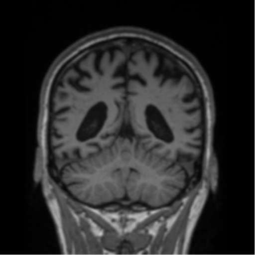Alzheimer's disease- with Gerstmann syndrome and dressing apraxia (Radiopaedia 54882-61150 Coronal T1 28).png