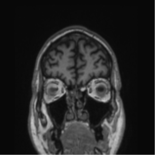 Alzheimer's disease- with Gerstmann syndrome and dressing apraxia (Radiopaedia 54882-61150 Coronal T1 78).png
