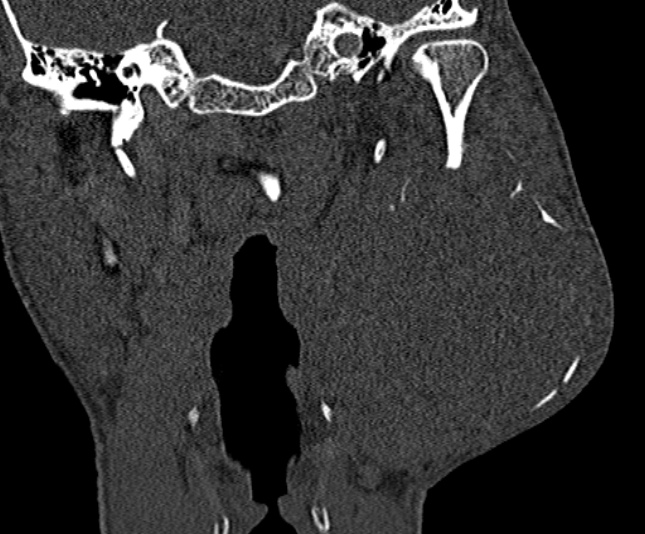 Ameloblastoma (Radiopaedia 51921-57766 Coronal bone window 188).jpg