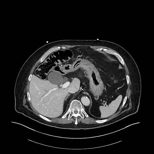 Ampullary adenocarcinoma (Radiopaedia 59373-66734 C 40).jpg