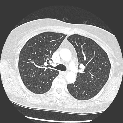Amyloidosis - bronchial and diffuse nodular pulmonary involvement (Radiopaedia 60156-67745 Axial lung window 28).jpg