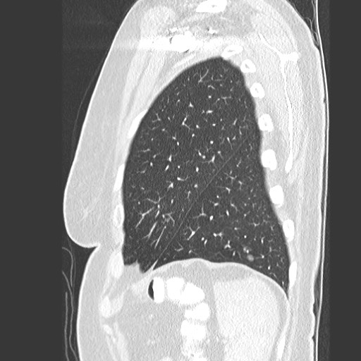 Amyloidosis - bronchial and diffuse nodular pulmonary involvement (Radiopaedia 60156-67745 Sagittal lung window 78).jpg