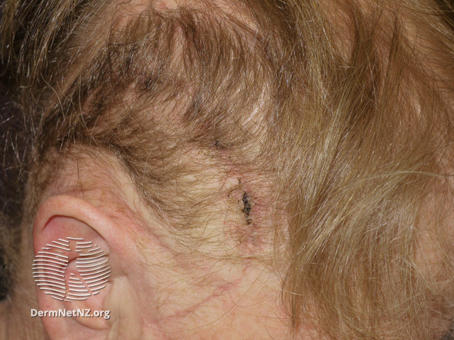 File:Anagen effluvium due to cranial irradiation (DermNet NZ hair-nails-sweat-anagen-effluvium-13).jpg