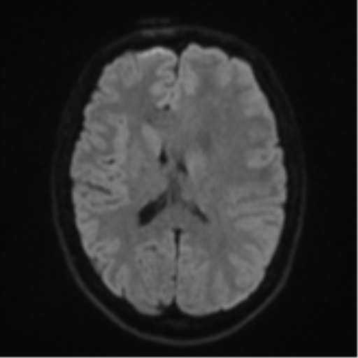 File:Anaplastic astrocytoma (Radiopaedia 57768-64731 Axial DWI 44).png