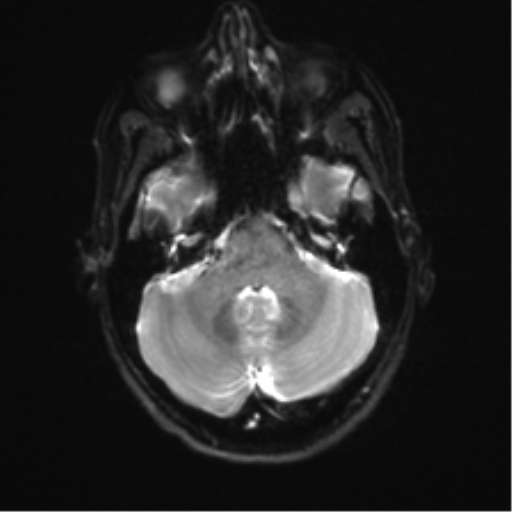 Anaplastic astrocytoma IDH mutant (Radiopaedia 50046-55341 Axial DWI 7).png