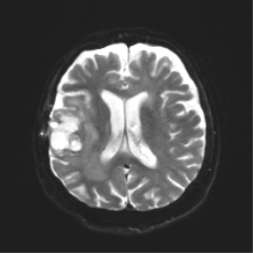 File:Anaplastic astrocytoma IDH wild-type (pseudoprogression) (Radiopaedia 42209-45279 Axial DWI 16).png