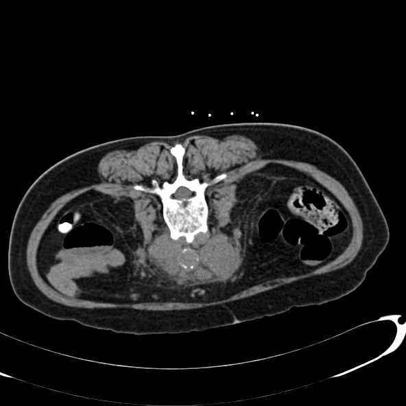 Anaplastic lymphoma - with CT biopsy (Radiopaedia 21643-21602 Axial non-contrast 46).jpg