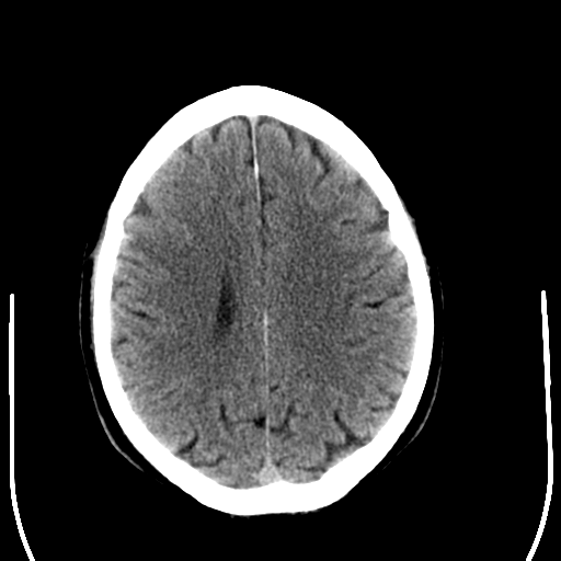 File:Anaplastic meningioma with recurrence (Radiopaedia 34452-35781 Axial non-contrast 23).png