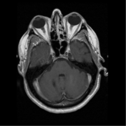 File:Anaplastic meningioma with recurrence (Radiopaedia 34452-35783 Axial T1 C+ 5).png