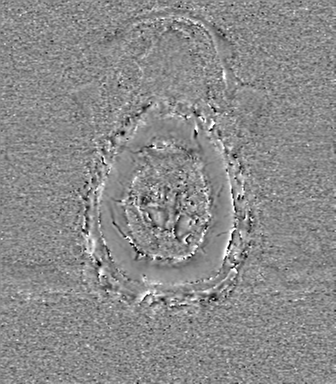 Anaplastic oligodendroglioma (Radiopaedia 83500-98599 Axial SWI - phase 86).png