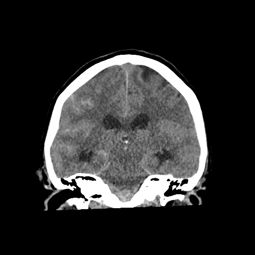 Aneursym related subarachnoid hemorrhage with hydrocephalus (Radiopaedia 45105-49083 Coronal non-contrast 38).jpg