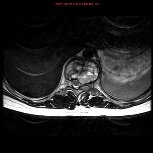 File:Aneurysmal bone cyst (Radiopaedia 9419-10103 Axial T2 12).jpg